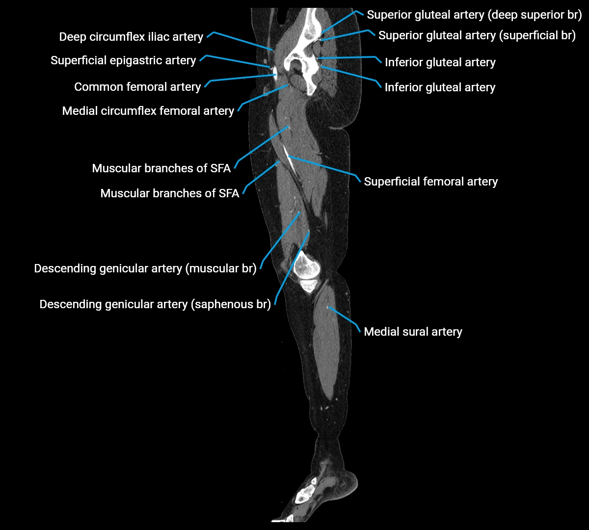 CTA lower limb sagittal cross sectional anatomy labelled image _28 (4).webp